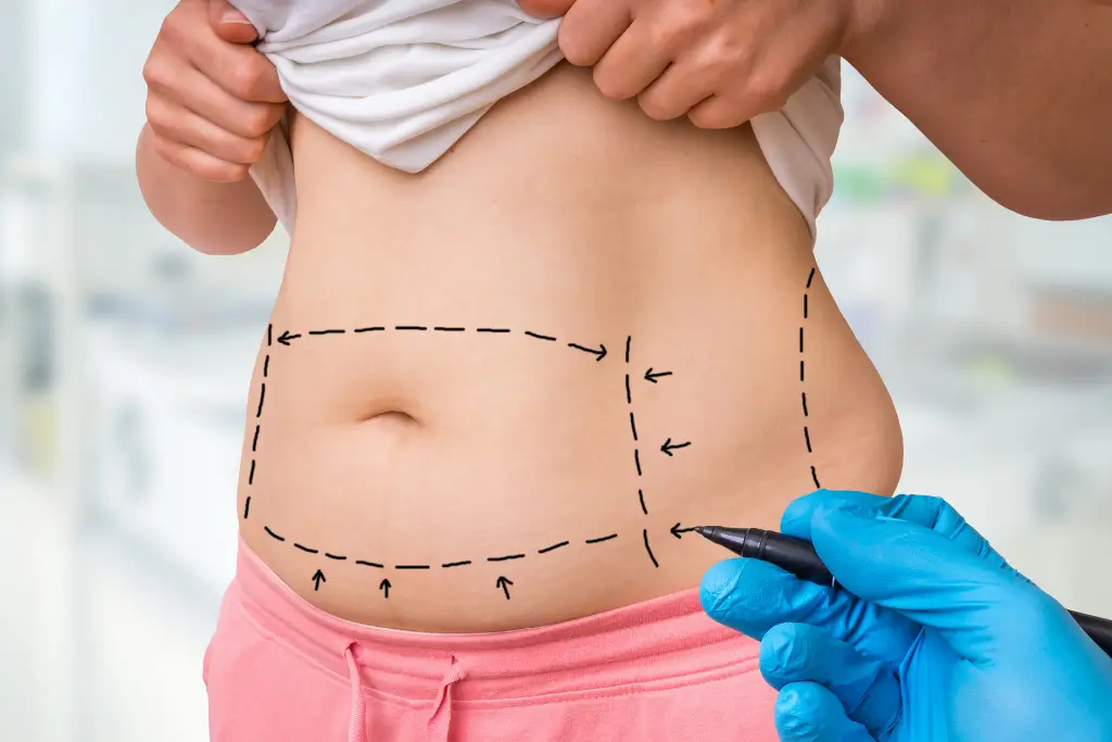 Vücut Şekillendirme ve Liposuction İçin En Doğru Zaman Ne Zaman