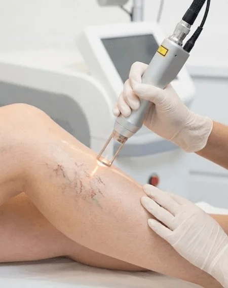 Yağ Lazer Kılcal Damar Tedavisi