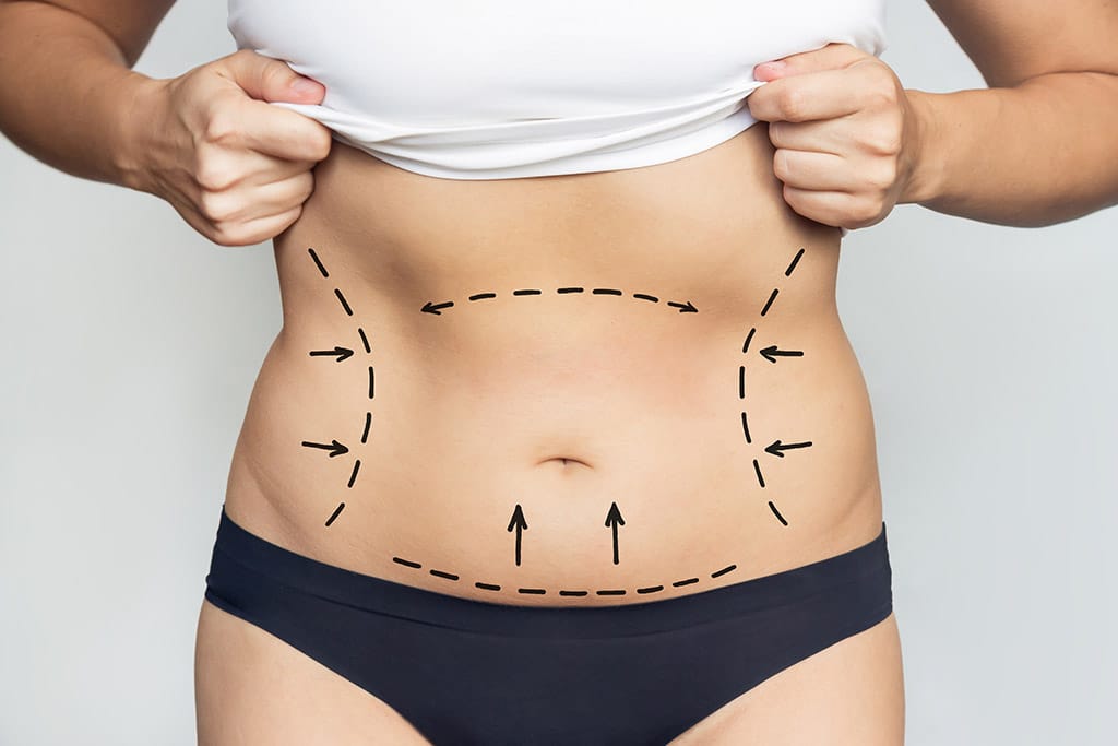 liposuction-nedir